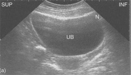Bladder Ultra Sound